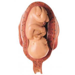 Utérus avec foetus dans le 7. mois